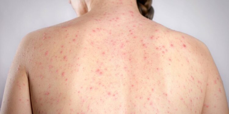 Morbillo, è allarme negli Usa. Italia prima per casi in Europa in in primi 6 mesi 2026